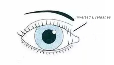 Inverted-Eyelashes-2-1